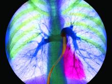 Colored angiogram (x-ray) of left and right pulmonary arteries in healthy lungs. The common pulmonary artery divides (at center, dark blue) into thick left and right branches.